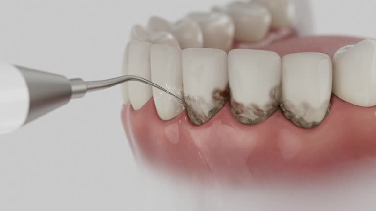 Trusted Wisdom Tooth Removal service in Lowell, MI - Dentist Open Now
